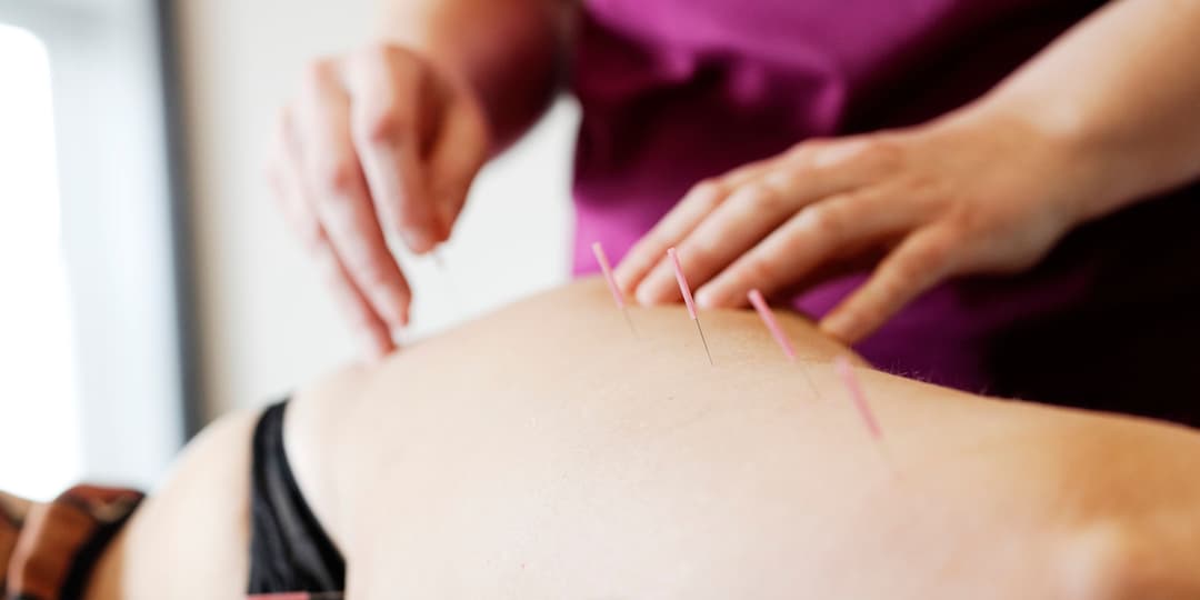 Akupunktur